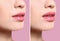 Woman before and after lips augmentation procedure on color background