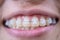 Woman mouth smiling with white braces and healthy teeth for beaty and healthy teeth concept