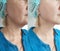 Woman neck wrinkles facelift before after correction treatment removal