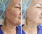 Woman neck wrinkles facelift  before after treatment removal