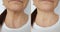 Woman neck wrinkles before  after treatment