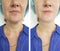 Woman neck wrinkles before after treatment removal