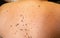 Woman patient on clinical trials with lot on brown nevus on body back