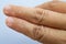 Woman peeled index finger and scar skin on hand, White background, Close up & Macro shot, Asian Body skin part, Healthcare concept