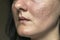 Woman with problematic skin and acne scars. Pigmentation on face woman. Problem skin care and health concept.