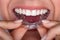 Woman Putting Transparent Aligner In Teeth