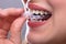 Woman Putting Transparent Aligner In Teeth