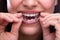 Woman Putting Transparent Aligner In Teeth