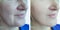 Woman removal wrinkles difference regeneration plastic result before therapy correction after treatment