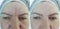 Woman removal wrinkles face patient biorevitalizationbefore and after regenerationtreatment