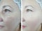 woman removal wrinkles rejuvenation difference  result before therapy correction after treatment