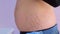 Woman`s abdomen after carboxytherapy injections in clinic, closeup side view.