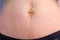 Woman`s abdomen after childbirth and pregnancy, skin with heavy stretches.