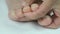 Woman\'s feet with fungal infections of toenails