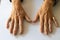 Woman`s hands affected by arthritis