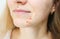 Woman`s oily skin with acne problems. Scars and wounds on the face. Health care photo