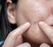 Woman`s problematic skin , acne scars ,oily skin and pore, dark spots and blackhead and whitehead on the face