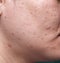 Woman`s problematic skin , acne scars ,oily skin and pore, dark spots and blackhead and whitehead on the face