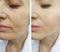 Woman sagging before after collage effect treatment tightening procedures