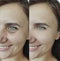 Woman sagging puffy pigmentation effect wrinkles beautician therapy regeneration before and after treatment collage