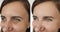 Woman sagging puffy rejuvenation effect wrinkles beautician therapy regeneration before and after treatment collage