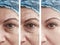 Woman skin wrinkles removal before cosmetology after collage cosmetology regeneration treatments contrast