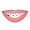 Woman Smile with braces on crooked teeth. Vector illustration, flat style. Dentist and orthodontist treatment icon