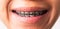 Woman smile show mouth with white teeth with black brackets braces