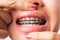 Woman smile show mouth with white teeth with black brackets braces