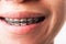 Woman smile show mouth with white teeth with black brackets braces