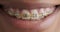 Woman smiling with dental braces