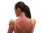 Woman with sunburned skin on white background, back view