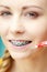 Woman with teeth braces using interdental brush