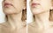 Woman tightening the chin correction collage before and after the procedure treatment