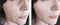 Woman wrinkles before and after  antiaging procedures