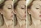 Woman wrinkles arrow sagging skin cosmetology correction after lifting plastic filler