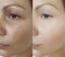 Woman wrinkles beautician effect collagen mature lifting revitalization before and after treatment result