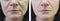 Woman wrinkles beautician on face before and after lifting cosmetic procedures