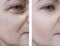 Woman wrinkles beautician on face patient before and after lifting cosmetic procedures