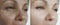 Woman   wrinkles beautician mature lifting revitalization before and after treatment result