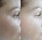 Woman wrinkles beautician regeneration effect collagen mature lifting revitalization before and after treatment result