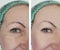 Woman wrinkles before after cosmetology procedures