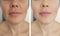 Woman wrinkles before and after cosmetology procedures