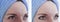 Woman wrinkles before and after difference antiaging procedures