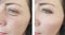 Woman wrinkles before and after difference lift antiaging procedures