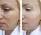 Woman wrinkles before and after effect   correction contrast  results treatments