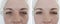 Woman wrinkles eye face before and after regeneration mature treatment cosmetology treatments