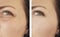 Woman wrinkles face beautician difference regeneration before and after treatments