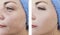 Woman wrinkles face beautician difference before and after treatments