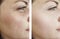 Woman wrinkles face beautician effect therapydifference regeneration before and after treatments